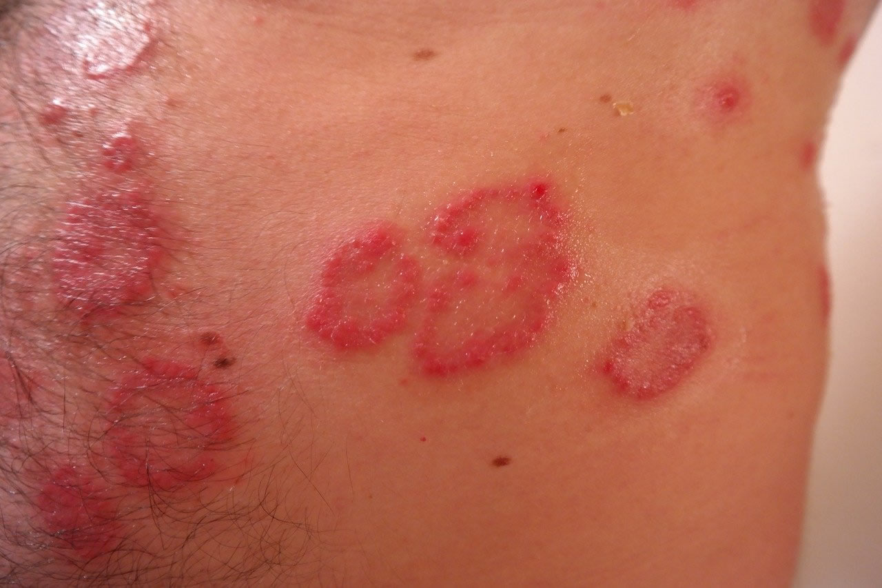 Псориазис - виж какво го причинява! Какви са симптомите и как да се лекуваме? psoriazis vij kakvo go prichinqva kakwi sa simptomite i kak da se lekuvame